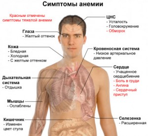 Симптомы малокровии или анемии